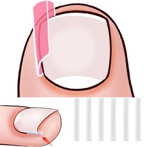 스틱 말린발톱 내향성발톱 보호 발톱와이어 발톱테이프 지지대 테이핑 파고드는 발톱 내향형발톱, 사각타입