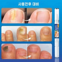 발톱무좀치료 발톱무좀약 손발톱 네일 리페어 강화 에센스, 3ml, 5개