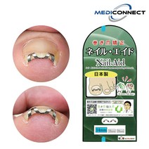 메디커넥트 네일에이드 내성발톱 교정기 내향성발톱 자가치료, 1개