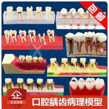 치아모형 재료상 입모형 모양 구강수업모델 치과와구 폐쇄모델 치주병, 04 충치발전모델 4011
