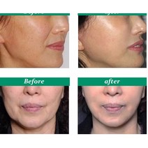 얼굴 리프팅 기계 마사지기 미용기기 입술 주사기 보톡스 필러 3D 조각 LED 조명 사인 소매 메디, 01 BOTOX 100iu