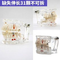 치아모형 인체모형도 치과기구 실리콘몰드 인체모형 양치교구 재료상, 빠지거나 길어진 31개 치아(탈착불가)