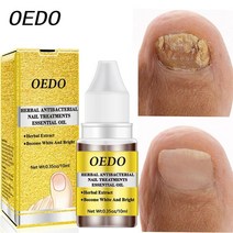 손톱 내성발톱 무좀 곰팡이 연화제 항균 큐티클 오일 에센스 oedo fungus nail repair serum Herbal anti fungal treatment toe nail, 없음