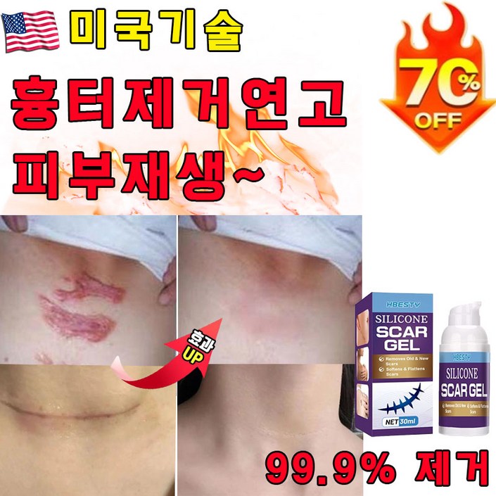 [독일기술] 1/1+1 흉터제거 연고 제왕절개 화상흉터 재생크림 수술 상처 흉터 연고