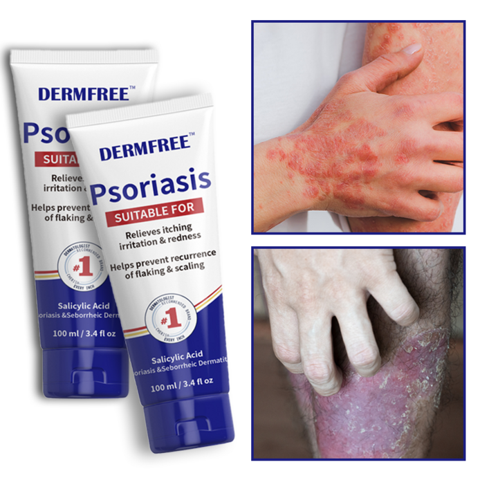 DERMFREE 건선 크림 습진 두드러기 피부염 두피건선 피부 가려움증, 2개, 100ml DERMFREE 건선 크림 습진 두드러기 피부염 두피건선 피부 가려움증, 2개, 100ml